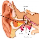 What is impacted ear wax